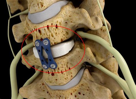Methods Patients who underwent three- or four-level anterior cervical discectomy with plate fixation between 2006 and 2011 from a single-center multi-surgeon practice for symptomatic cervical degenerative disease were identified. . Anterior cervical discectomy and fusion settlement
